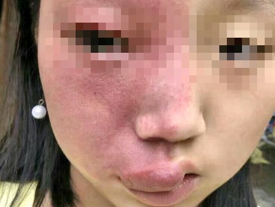 鲜红斑痣的是否是因遗传而出现的？