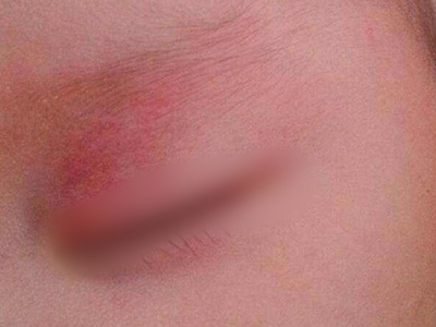 鲜红斑痣的是否是因遗传而出现的？