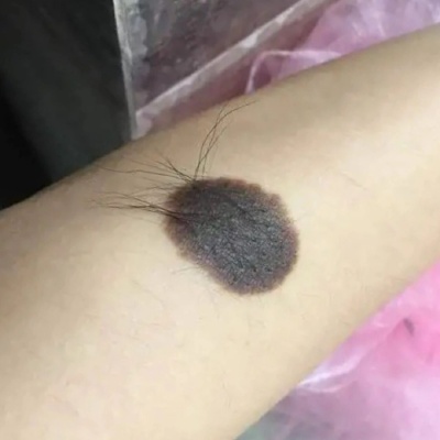 黑毛痣和黑色胎记区别是什么?